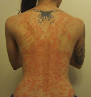 What A Psoriasis Outbreak Looks Like for Lissa