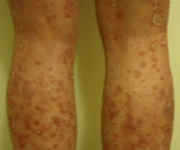 A Photo of Lissa's Legs During an Psoriasis Outbreak
